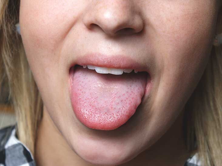 Tongue Herpes